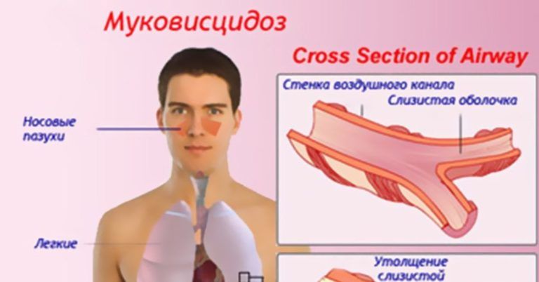 Муковисцидоз – от слова мýка?