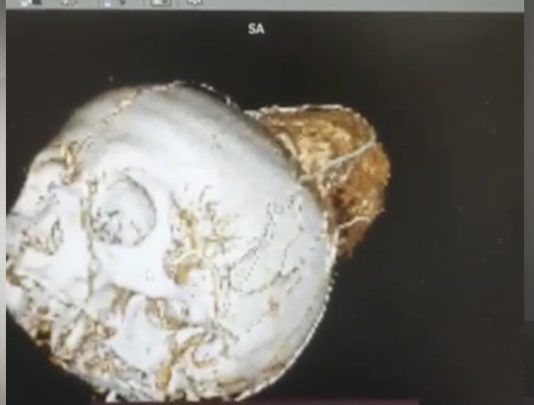 Врачи в Махачкале удалили у женщины гигантскую опухоль головного мозга