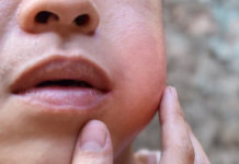 5 случаев заболеваемости свинкой выявили в махачкалинской школе