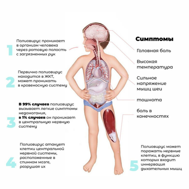 Полиомиелит… Не оставить ребенка неподвижным